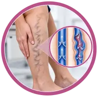 Varicose Veins